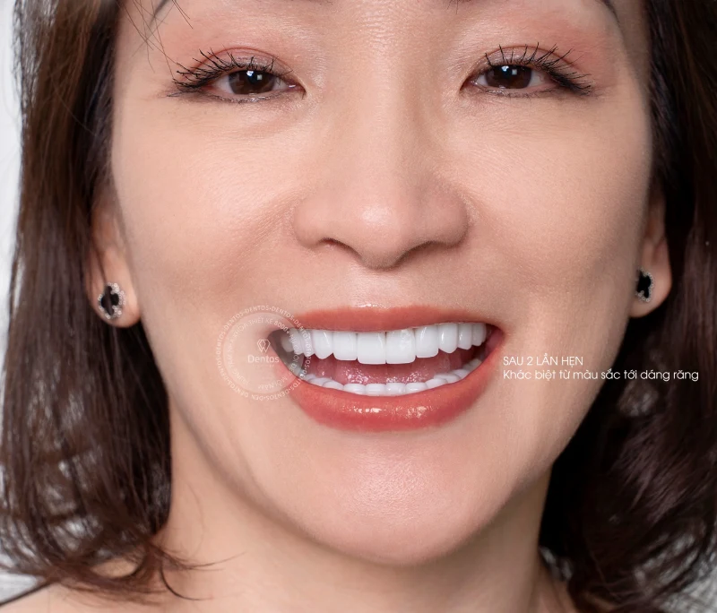 Quy trình dán sứ Veneer chuẩn quốc tế & các lựa chọn tại Dentos